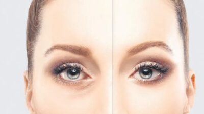 Dermatolojideki birçok tedavi seçeneği ile göz altı morluklarından kurtulmak mümkün.