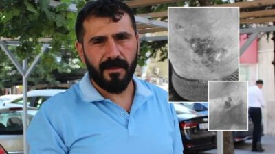 Kayseri'de kuaför Mehmet Uğuş, bacağındaki varisten usandı. Bir tanıdığının önerisiyle