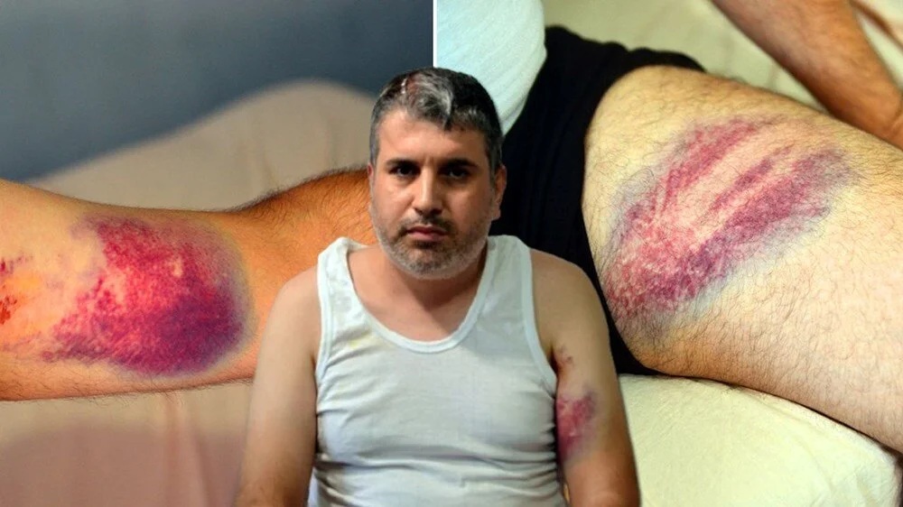 Adana’da miras anlaşmazlığı yaşadığı yeğeni Mehmet Alpaltun’u (38) beyzbol sopasıyla