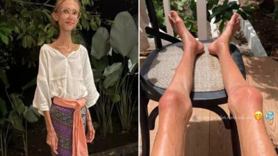 Uzun süredir meyve diyeti ile yaşamına devam eden ve son