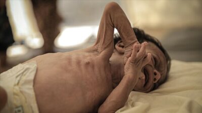 Bangladeş, kızamık salgınıyla mücadele ederken, son 24 saatte 8 çocuğun